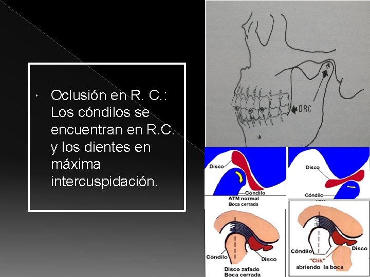  Oclusión en R. C. : Los cóndilos se encuentran en R. C. y