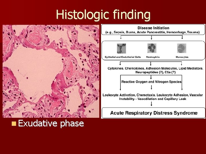 Histologic finding n Exudative phase 