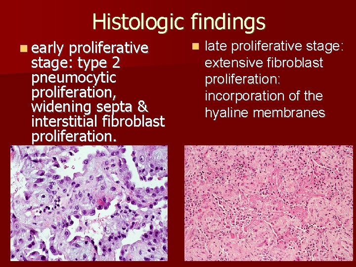 Histologic findings n early proliferative stage: type 2 pneumocytic proliferation, widening septa & interstitial