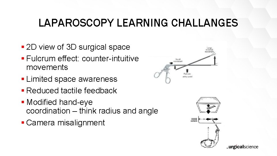 LAPAROSCOPY LEARNING CHALLANGES § 2 D view of 3 D surgical space § Fulcrum