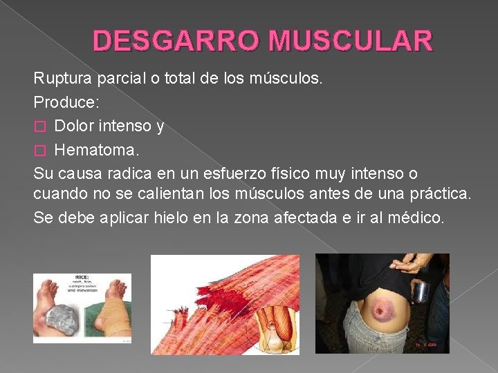 DESGARRO MUSCULAR Ruptura parcial o total de los músculos. Produce: � Dolor intenso y