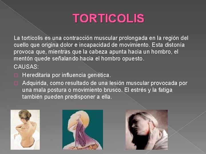 TORTICOLIS La tortícolis es una contracción muscular prolongada en la región del cuello que