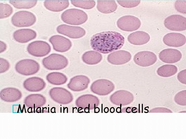 �Malaria in red blood cells 