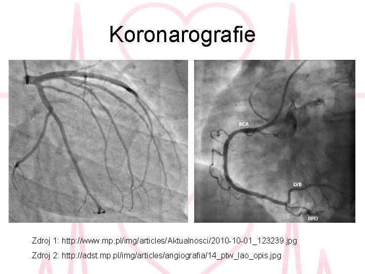 Koronarografie Zdroj 1: http: //www. mp. pl/img/articles/Aktualnosci/2010 -10 -01_123239. jpg Zdroj 2: http: //adst.