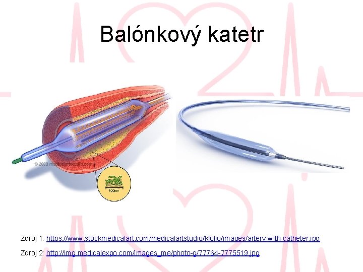 Balónkový katetr Zdroj 1: https: //www. stockmedicalart. com/medicalartstudio/kfolio/images/artery-with-catheter. jpg Zdroj 2: http: //img. medicalexpo.