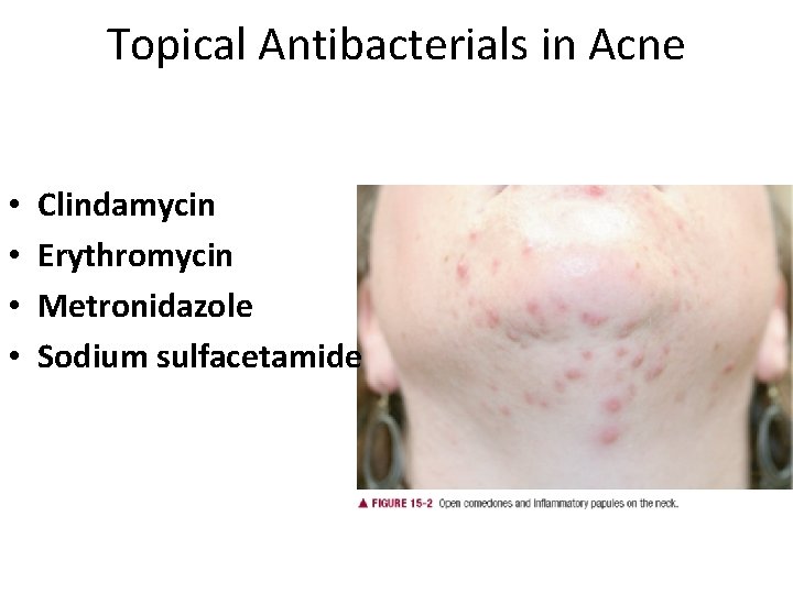 Topical Antibacterials in Acne • • Clindamycin Erythromycin Metronidazole Sodium sulfacetamide 