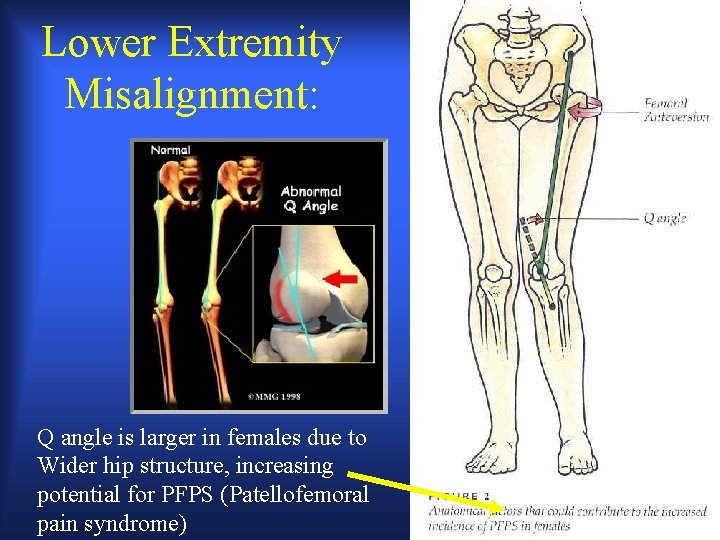 Lower Extremity Misalignment: Q angle is larger in females due to Wider hip structure,