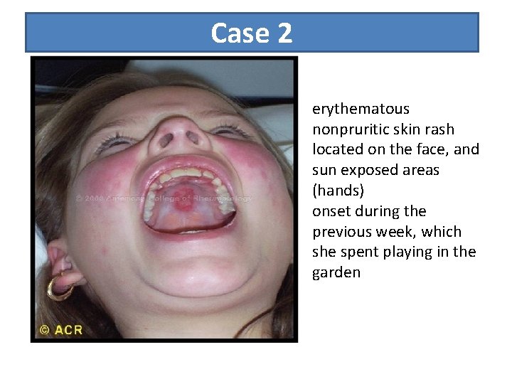 Case 2 erythematous nonpruritic skin rash located on the face, and sun exposed areas Case 2 erythematous nonpruritic skin rash located on the face, and sun exposed areas