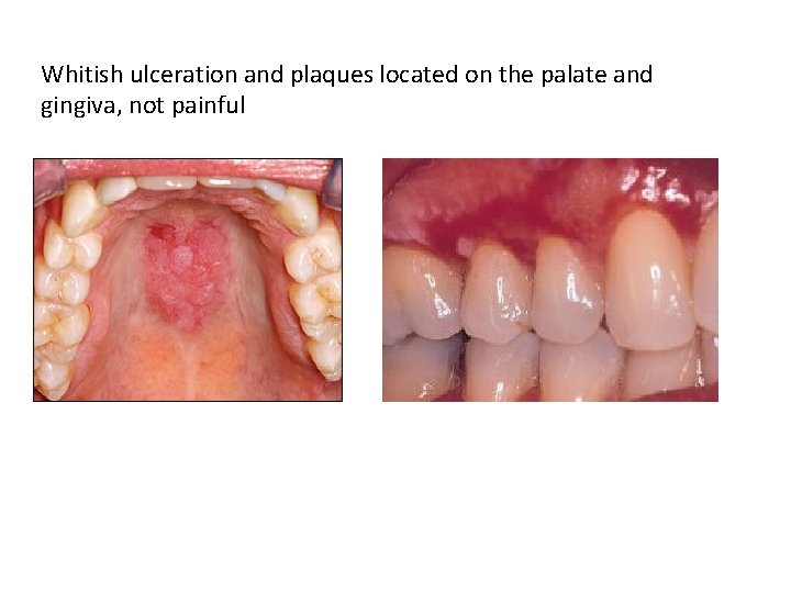 Whitish ulceration and plaques located on the palate and gingiva, not painful Whitish ulceration and plaques located on the palate and gingiva, not painful