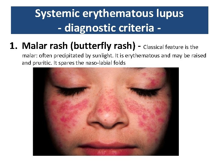 Systemic erythematous lupus - diagnostic criteria 1. Malar rash (butterfly rash) - Classical feature Systemic erythematous lupus - diagnostic criteria 1. Malar rash (butterfly rash) - Classical feature