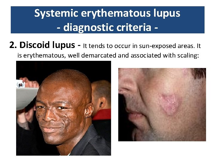Systemic erythematous lupus - diagnostic criteria 2. Discoid lupus - It tends to occur Systemic erythematous lupus - diagnostic criteria 2. Discoid lupus - It tends to occur