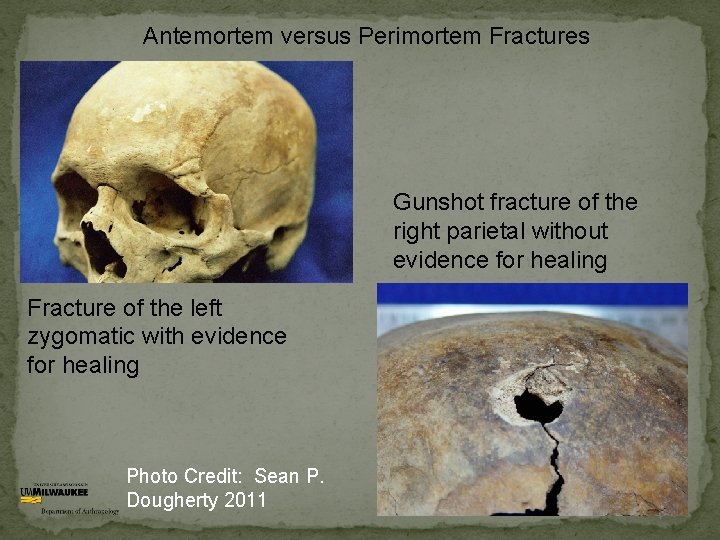 Antemortem versus Perimortem Fractures Gunshot fracture of the right parietal without evidence for healing