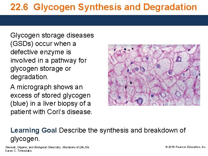 22. 6 Glycogen Synthesis and Degradation Glycogen storage diseases (GSDs) occur when a defective