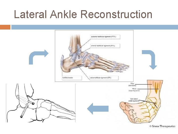 Lateral Ankle Reconstruction 