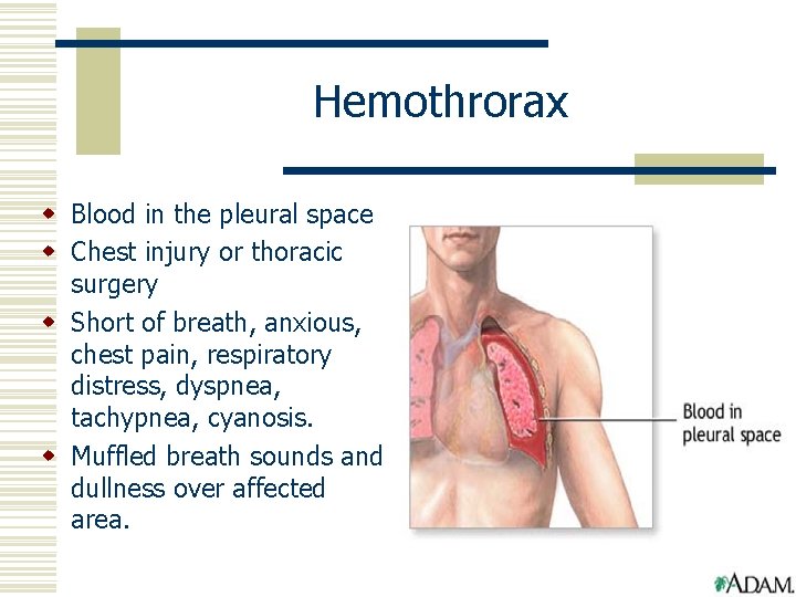 Hemothrorax w Blood in the pleural space w Chest injury or thoracic surgery w