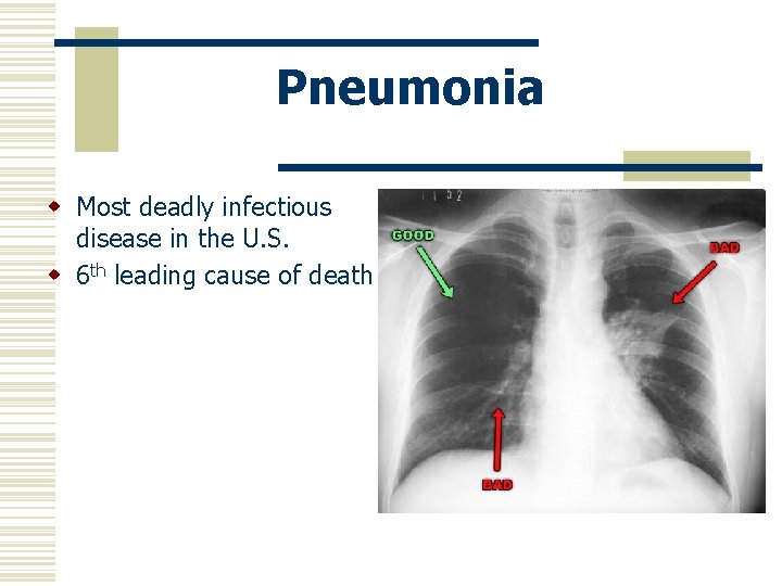 Pneumonia w Most deadly infectious disease in the U. S. w 6 th leading