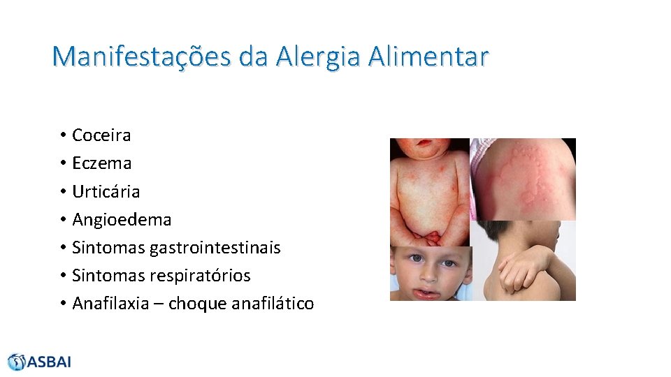 Manifestações da Alergia Alimentar • Coceira • Eczema • Urticária • Angioedema • Sintomas