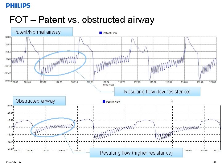 FOT – Patent vs. obstructed airway Patent/Normal airway Resulting flow (low resistance) Obstructed airway