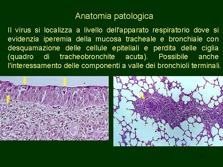 Anatomia patologica Il virus si localizza a livello dell'apparato respiratorio dove si evidenzia iperemia