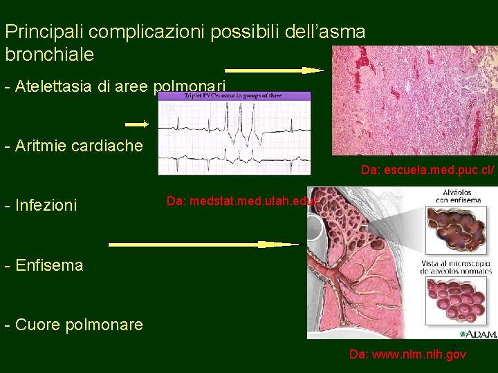 Principali complicazioni possibili dell’asma bronchiale - Atelettasia di aree polmonari - Aritmie cardiache Da: