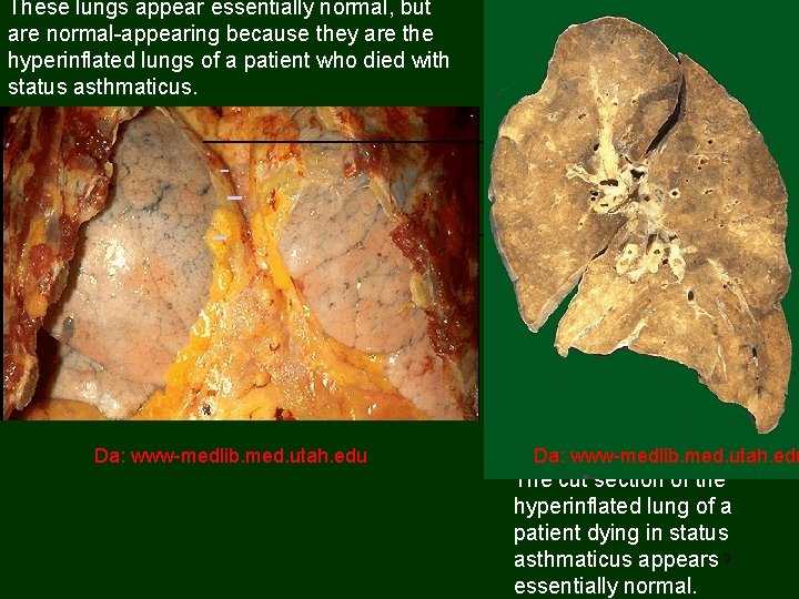 These lungs appear essentially normal, but are normal-appearing because they are the hyperinflated lungs
