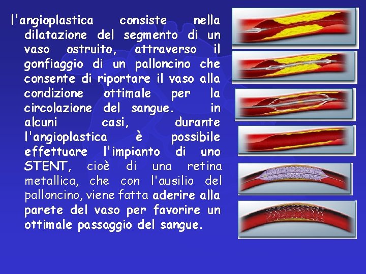 l'angioplastica consiste nella dilatazione del segmento di un vaso ostruito, attraverso il gonfiaggio di