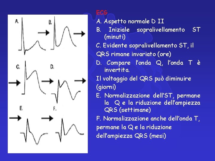 ECG A. Aspetto normale D II B. Iniziale sopralivellamento ST (minuti) C. Evidente sopralivellamento