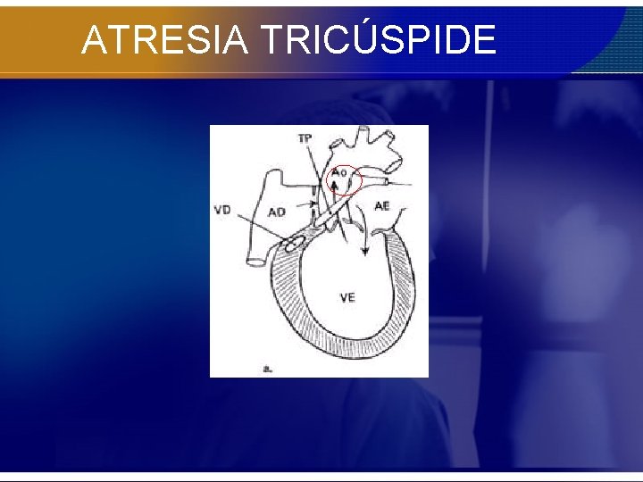 ATRESIA TRICÚSPIDE 