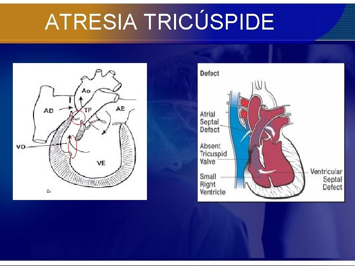 ATRESIA TRICÚSPIDE 