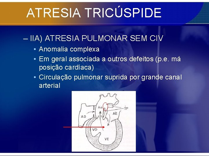 ATRESIA TRICÚSPIDE – IIA) ATRESIA PULMONAR SEM CIV • Anomalia complexa • Em geral