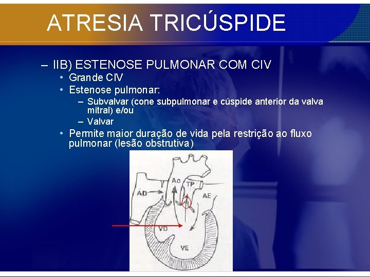 ATRESIA TRICÚSPIDE – IIB) ESTENOSE PULMONAR COM CIV • Grande CIV • Estenose pulmonar: