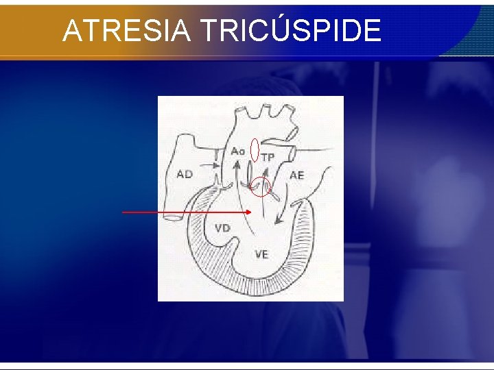 ATRESIA TRICÚSPIDE 