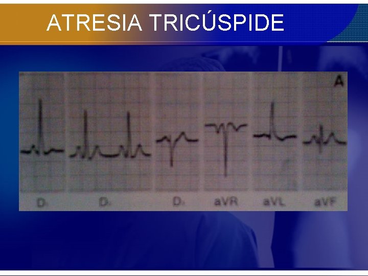 ATRESIA TRICÚSPIDE 