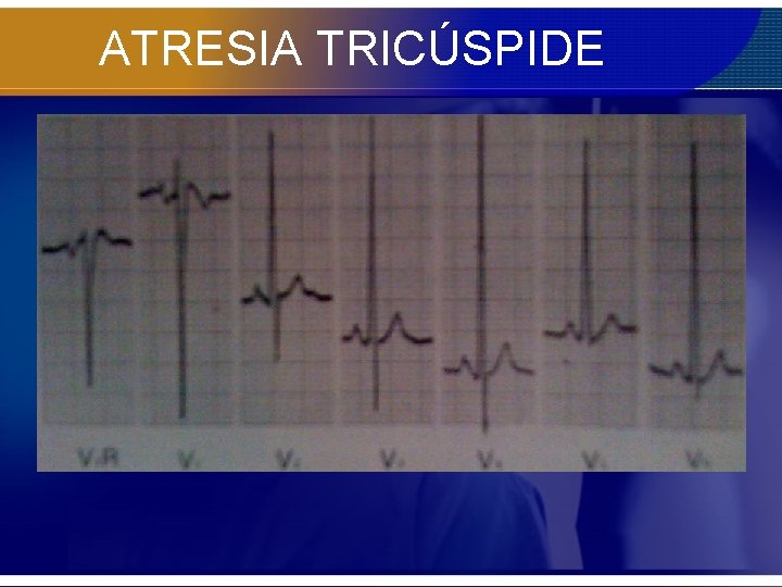 ATRESIA TRICÚSPIDE 