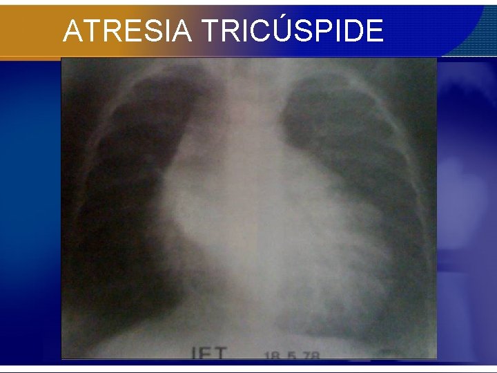 ATRESIA TRICÚSPIDE 