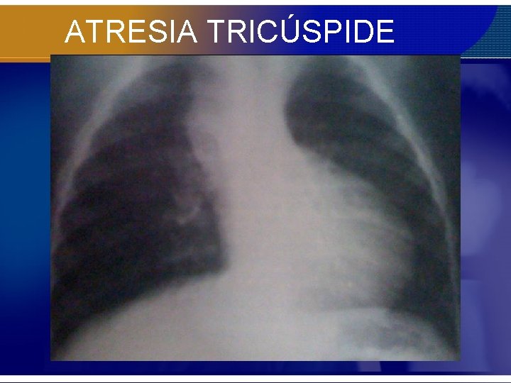 ATRESIA TRICÚSPIDE 