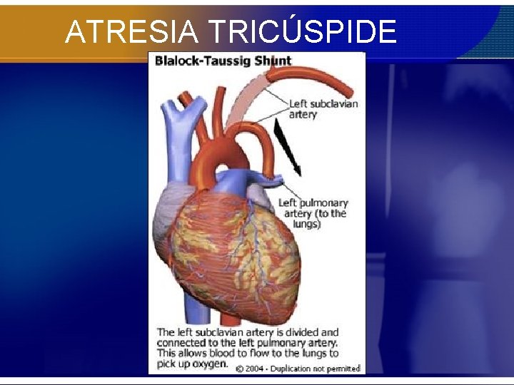 ATRESIA TRICÚSPIDE 