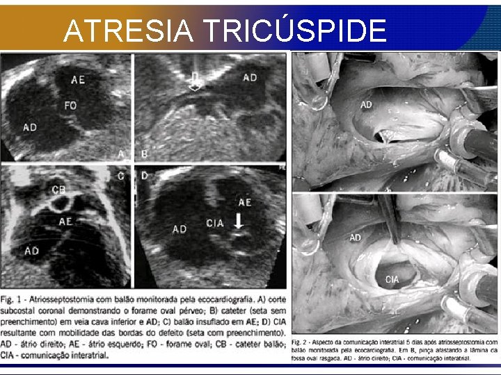 ATRESIA TRICÚSPIDE 