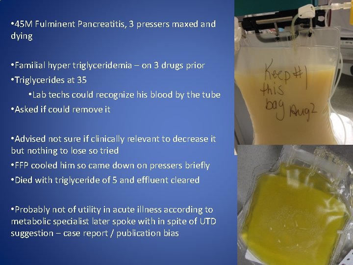  • 45 M Fulminent Pancreatitis, 3 pressers maxed and dying • Familial hyper