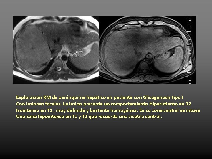 Exploración RM de parénquima hepático en paciente con Glicogenosis tipo I Con lesiones focales.