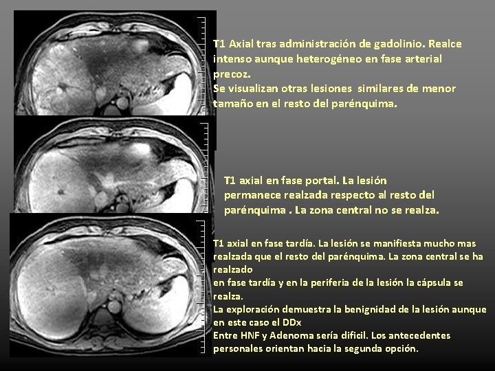 T 1 Axial tras administración de gadolinio. Realce intenso aunque heterogéneo en fase arterial