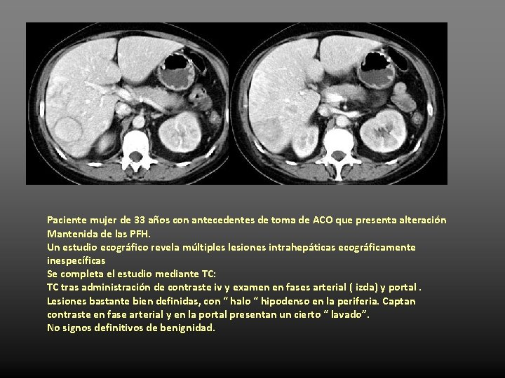 Paciente mujer de 33 años con antecedentes de toma de ACO que presenta alteración