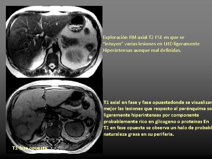 Exploración RM axial T 2 FSE en que se “intuyen” varias lesiones en LHD