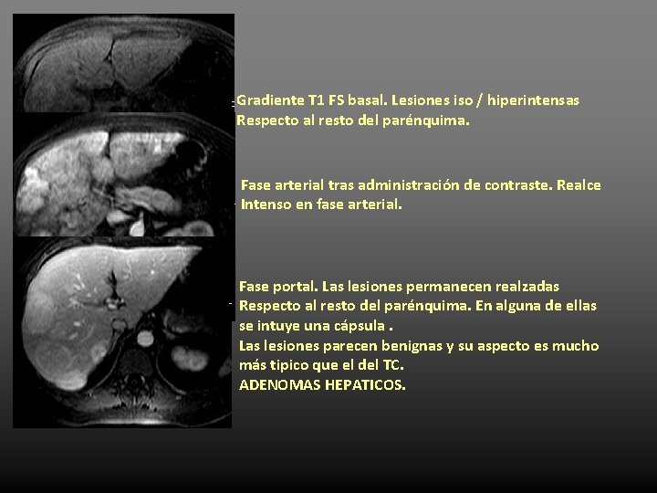 Gradiente T 1 FS basal. Lesiones iso / hiperintensas Respecto al resto del parénquima.