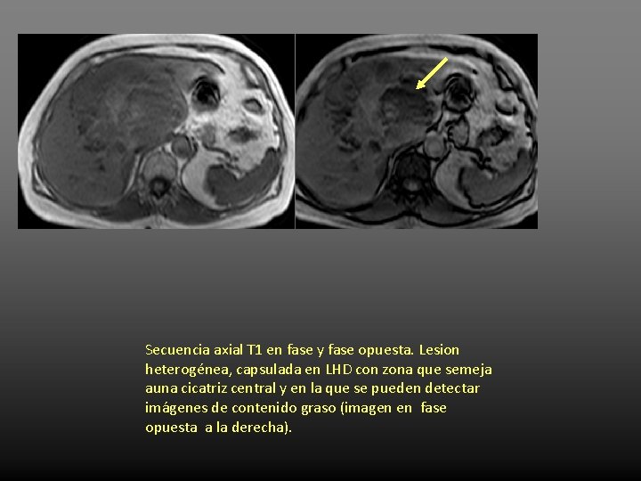 Secuencia axial T 1 en fase y fase opuesta. Lesion heterogénea, capsulada en LHD