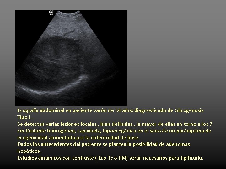 Ecografía abdominal en paciente varón de 34 años diagnosticado de Glicogenosis Tipo I. Se