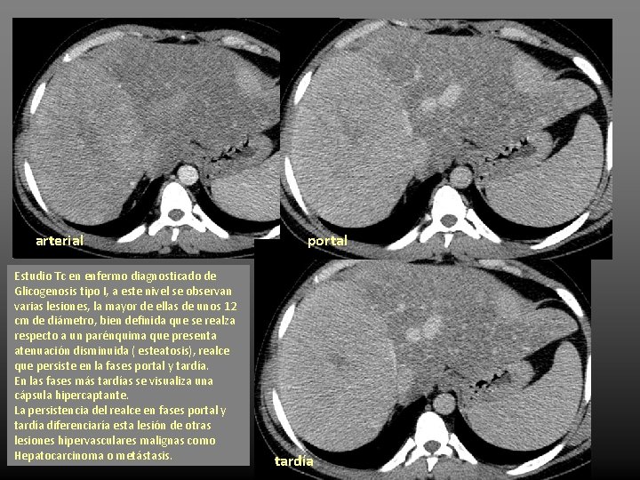 arterial Estudio Tc en enfermo diagnosticado de Glicogenosis tipo I, a este nivel se