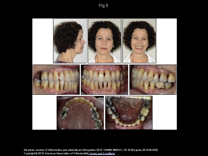 Fig 9 American Journal of Orthodontics and Dentofacial Orthopedics 2013 144455 -465 DOI: (10.