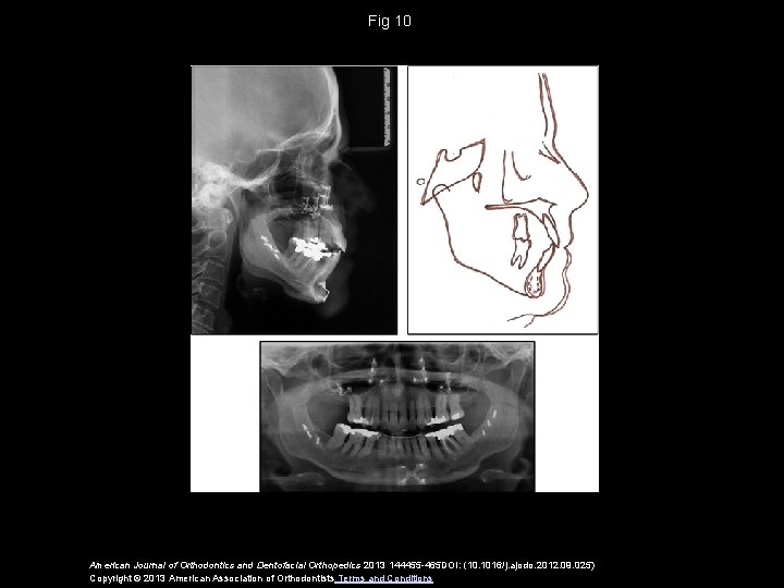 Fig 10 American Journal of Orthodontics and Dentofacial Orthopedics 2013 144455 -465 DOI: (10.