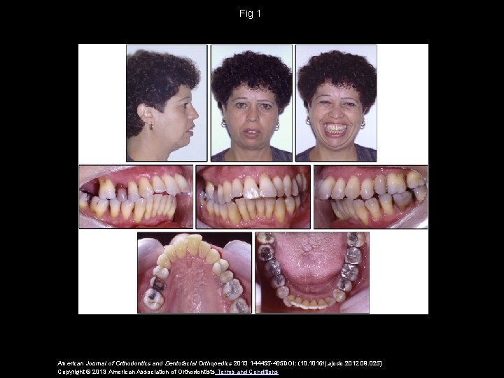 Fig 1 American Journal of Orthodontics and Dentofacial Orthopedics 2013 144455 -465 DOI: (10.